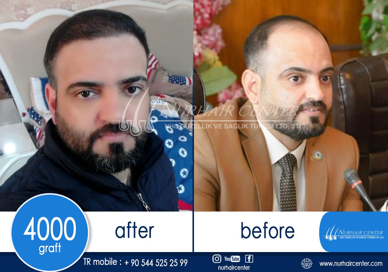 1 Month Results After My FUE Hair Transplant In Istanbul Turkey - YouTube